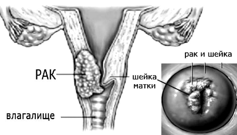 Карцинома шейки. Свишь при онкологии шейки матки. Свищ РШМ ректовагинальный. Раковые узлы на шейке матки.